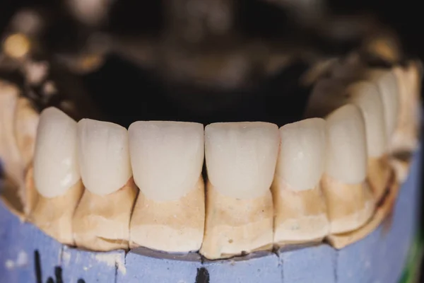 Close Uma Coroa Dental Cerâmica Livre Metal Artificial Modelo Gesso — Fotografia de Stock