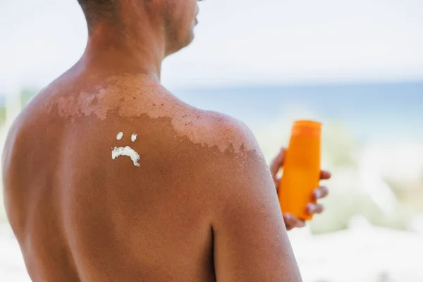 Close-up of a man\'s shoulder with sunburn. The skin sloughs off its his burn skin. It is the cause of melanoma.