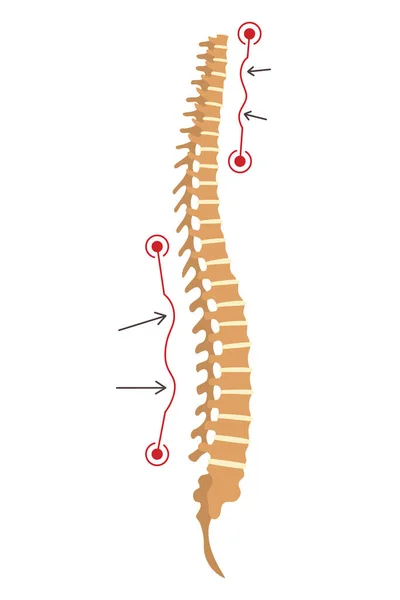 脊髄変形 脊椎の曲率や不健康な背骨のシンボル 人間の脊椎解剖学湾曲した脊椎 マークされたセクションを持つ図 体位欠陥 — ストックベクタ
