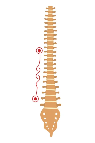 Deformidad Espinal Símbolo Curvaturas Columna Vertebral Espinas Insalubres Anatomía Columna — Vector de stock