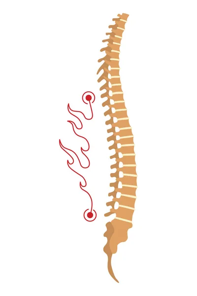 Деформація Хребта Символ Викривлення Хребта Або Нездорових Кісток Анатомія Хребта — стоковий вектор
