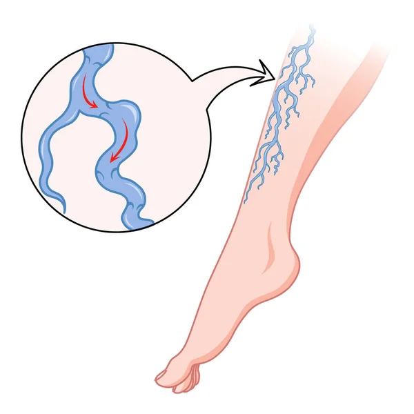 静脈瘤だ 皮膚を通して見える青い血管 異常に腫れ足 血管疾患の診断と治療 静脈不全医療フラット — ストックベクタ