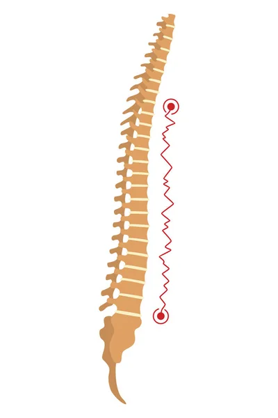 脊髄変形 脊椎の曲率や不健康な背骨のシンボル 人間の脊椎解剖学湾曲した脊椎 マークされたセクションを持つ図 体位欠陥 — ストックベクタ