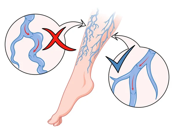 Żylaki Niebieskie Naczynie Krwionośne Widoczne Przez Skórę Nienormalnie Spuchnięta Noga — Wektor stockowy