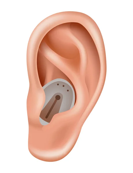 補聴器 難聴患者のためのサウンドアンプ 医学と健康 耳の後ろの現実的なオブジェクト 耳鼻咽喉科の治療と義肢 — ストックベクタ