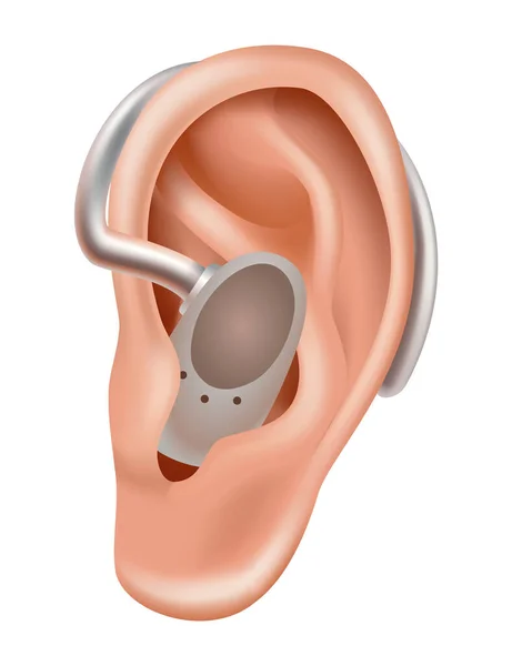 補聴器 難聴患者のためのサウンドアンプ 医学と健康 耳の後ろの現実的なオブジェクト 耳鼻咽喉科の治療と義肢 — ストックベクタ
