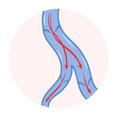 Varicose veins. Blue blood vessel visible through the skin. Vascular disease diagnostic and treatment. Venous insufficiency medical.