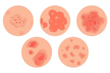 Farklı türde sedef taşıyıcı seti. Deri iltihabı, iltihap, kızarıklık ve diğer deri sorunları olan hastaların bir kısmı. Hastalık konsepti için çizgi film çizimi.