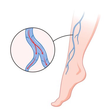 Varisli damarlar. Deriden görünen mavi kan damarı, anormal şişmiş bacak. Vasküler hastalık teşhisi ve tedavisi. Venöz Yetersiz Tıbbi Hastalık.