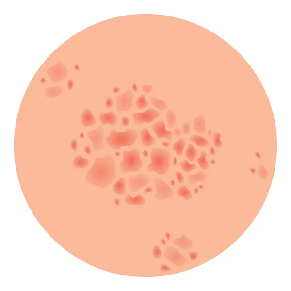 Type Psoriasis Vector Part Patients Skin Dermatitis Inflammation Red Rash — Stock Vector