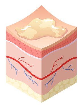 Cilt bakım konsepti. İnsan derisinin yatay katman yapısında kesit problemleri var. Anatomi modelinin sağlıksız cilt katmanı.