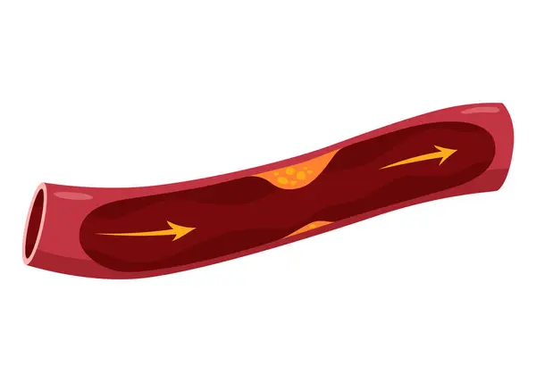 Åderförkalkning Stadium Hjärtinfarktens Anatomi Arteriosklerotisk Kärlsjukdom Eller Asvd Terosklerotisk Plack — Stock vektor