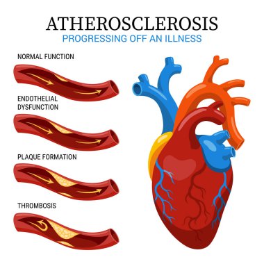Ateroskleroz aşamaları. Kalp krizinin anatomisi. Arteriosklerotik vasküler hastalık veya ASVD. Koroner arterde damar tıkanıklığı. Beyaz arkaplanda vektör illüstrasyonu.