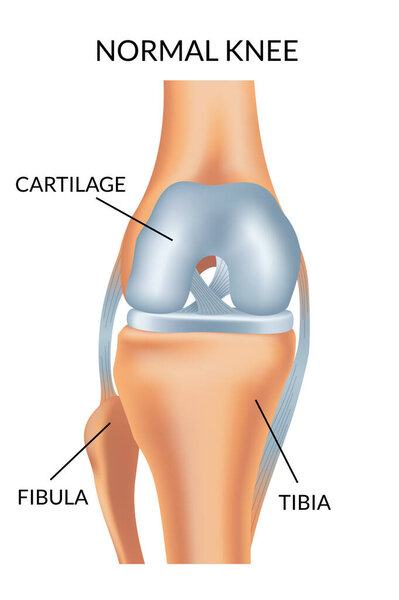 Knee arthrosis. Healthy knee structure. Bone exposure, healthy knee structure comparison. Medical poster with foot bones. Isolated vector illustration.
