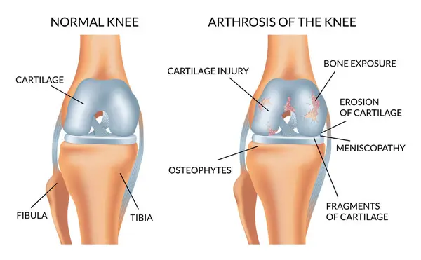 stock vector Knee arthrosis. Healthy knee and sore knee with damaged structure. Bone exposure damaged and healthy knee structure comparison. Medical poster with foot bones. Isolated vector illustration.