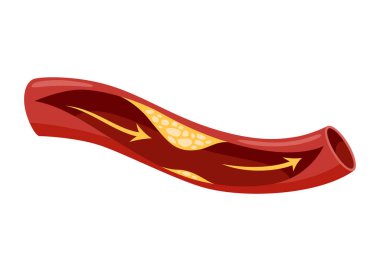 Atherosclerosis stage. Anatomy of heart attack. Arteriosclerotic vascular disease or ASVD. Atherosclerotic plaque in coronary artery. Vector illustration on white background. clipart