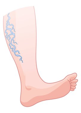 Varisli damarlar. Deriden görünen mavi kan damarı, anormal şişmiş bacak. Vasküler hastalık teşhisi ve tedavisi. Venöz Yetersiz Tıbbi Hastalık.