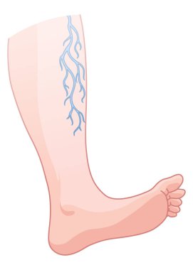 Varisli damarlar. Deriden görünen mavi kan damarı, anormal şişmiş bacak. Vasküler hastalık teşhisi ve tedavisi. Venöz Yetersiz Tıbbi Hastalık.