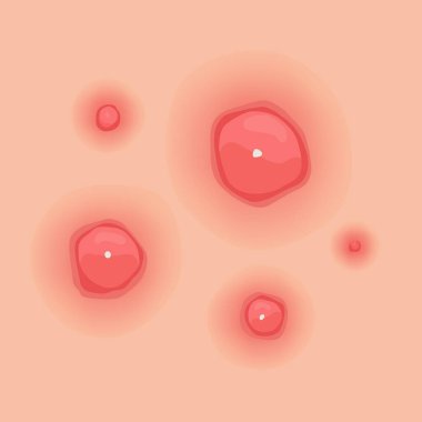 Bu bilgilendirici illüstrasyonla sivilcenin türünü keşfedin. Özellikleri hakkında bilgi edinName.