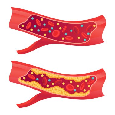 İnsan kan damarlarında kolesterol türleri. Hastalıkları açıklamak için normal ve daralmış arter. Yüksek yoğunluklu Lipoprotein HDL ve Düşük Yoğunluklu Lipoprotein LDL. Vektör illüstrasyonu.