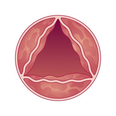 Tıbbi göstergeler aort kapakçığı ve stenozu gösteriyor. Vektör illüstrasyonu.