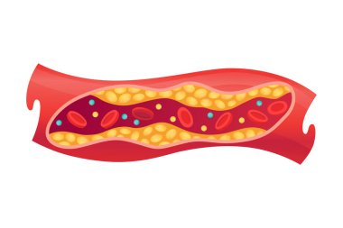 İnsan kan damarlarında kolesterol tipi. Açıklama hastalıkları için daraltılmış arter. Düşük yoğunluklu Lipoprotein LDL. Vektör illüstrasyonu.