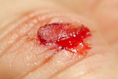 Derisi yüzülmüş, kırmızı kan ve lenf sıvısı yaradan akıyor. Elin orta parmağında kanama, makro atış.