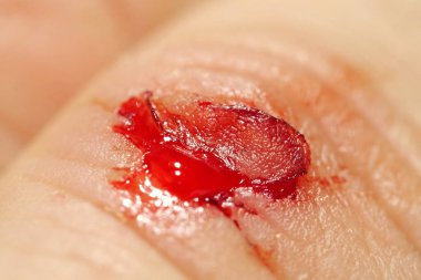 Flayed skin, red blood, lymphatic fluid flows from wound. Injury to middle finger of hand with bleeding, macro shot clipart