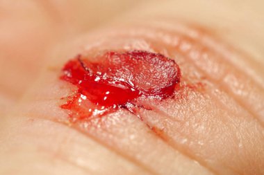 Flayed skin, red blood and lymphatic fluid flows from wound. Injury to middle finger of hand with bleeding, macro shot 2 clipart