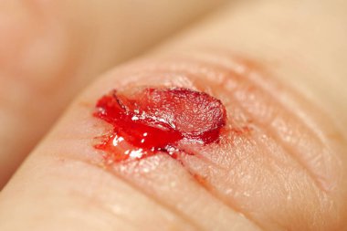 Derisi yüzülmüş, kırmızı kan ve lenf sıvısı yaradan akıyor. Parmağında kanama ve makro atış yarası var.