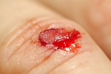 Derisi yüzülmüş, kırmızı kan ve lenf sıvısı yaradan akıyor. Elin orta parmağında kanama var, makro atış 3.