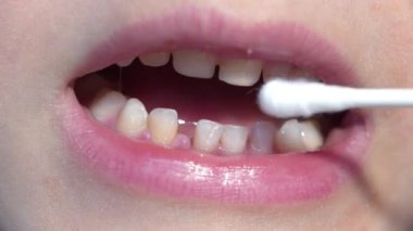 Bebek dişleri. İnsanlarda ilk diş seti. Ön kesici dişler, alt çenede düşmeden önce gevşerler. Doktor pamuk tomurcuğuyla dişlerini döker. Çocuk ağzı, kalıcı dişler süt dişlerinin yerini alır