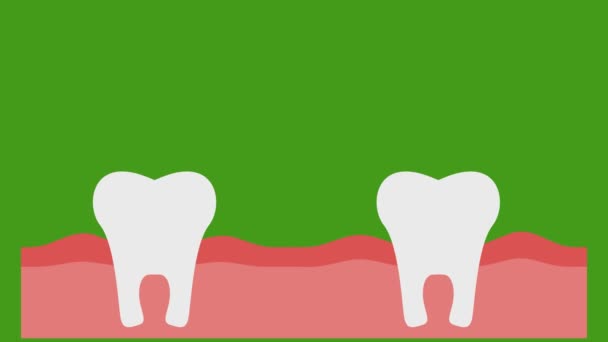Reparação Dentes Fundo Cromakey Vídeo — Vídeo de Stock