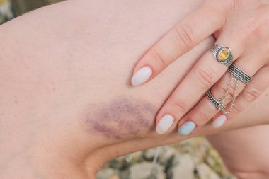 Kız bacağında bir çürük gösteriyor. Aile içi şiddet ve hematomanın tıbbi nedenleri.