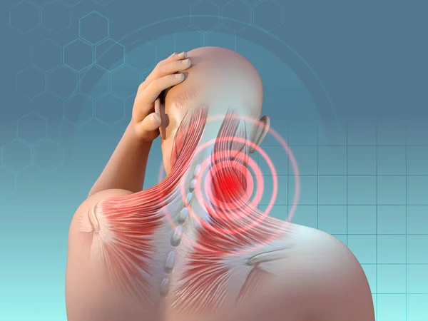 颈部和肩部肌肉疼痛 数字图解 3D渲染 免版税图库图片