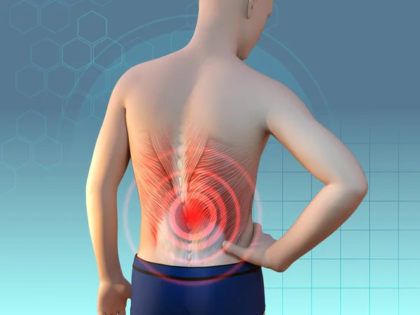 肌肉问题引起的背痛 数字图解 3D渲染 免版税图库照片