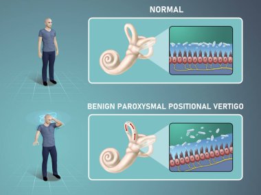 Benign paroxysmal positional vertigo. Vertigo caused by inner ear issues. Digital illustration, 3D render. clipart