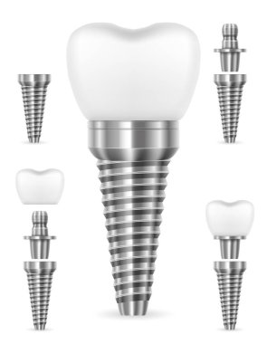 Diş metali insan implantı. Beyaz arka planda izole edilmiş hisse senedi vektör çizimi.