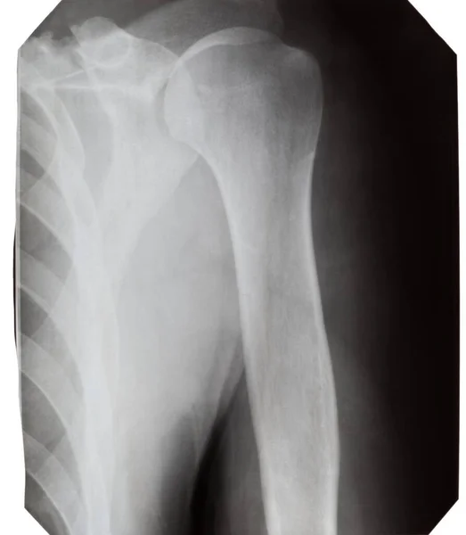 Beyaz Arka Planda Bir Adamın Omuz Röntgeni — Stok fotoğraf