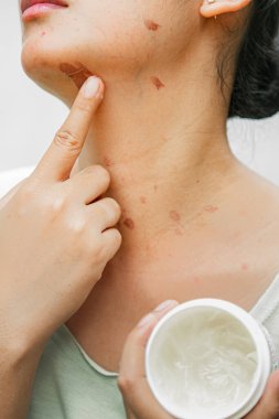Genç bir Asyalı kadın, krem kabını tutarken yüzündeki yanık izlerini gizlemek ve yatıştırmak için merhem sürüyor.
