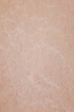 İnsan derisindeki gerilme izleri makro yakın görünüm