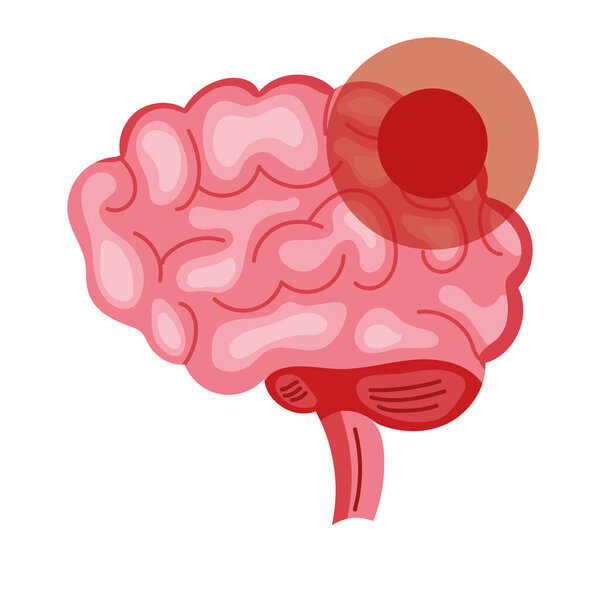 вектор состояния мозга Паркинсона