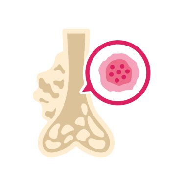 sarkoma ve kemik kanseri farkındalığı izole edildi