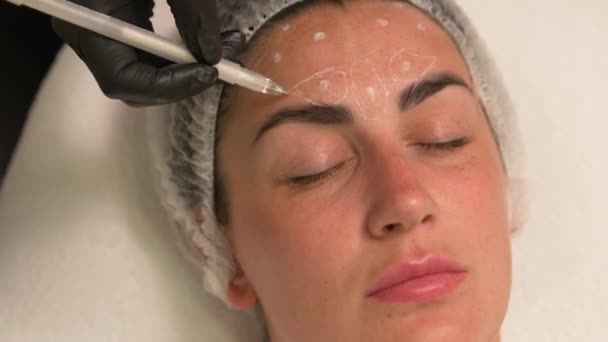 Cosmetologist Marks Pen Places Introduction Botox Drug Patients Forehead — Stock Video