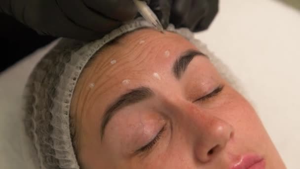 Cosmetologist Marks Pen Places Introduction Botox Drug Patients Forehead — Stock Video