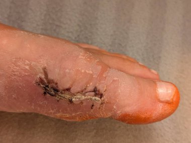 Ameliyattan bir hafta sonra parmağında yara izi var.