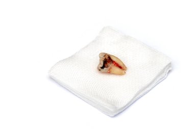 A decayed molar tooth is extracted. The blood hasn't dried yet. Lie down on white gauze. Isolated on a white background. Selective focus.