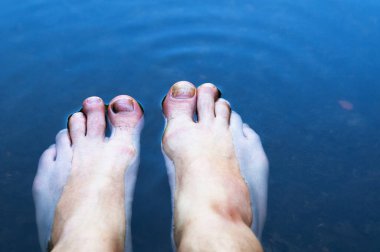 Suyun arka planında kırık ayak parmakları olan bir adamın ayakları. Ayak parmaklarında mantar hastalığı.