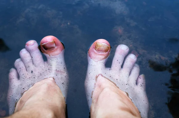 脚踏在水的背景上 脚趾头断了 脚趾上的真菌病 — 图库照片