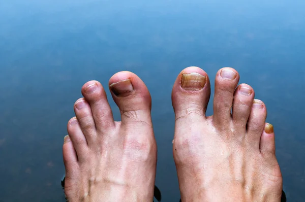 feet of a man with broken toes on the background of water. fungal disease on the toes.